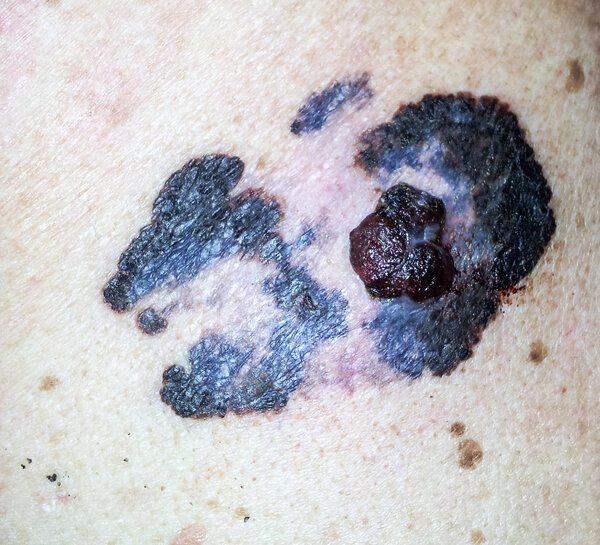 nodular melanoma photos