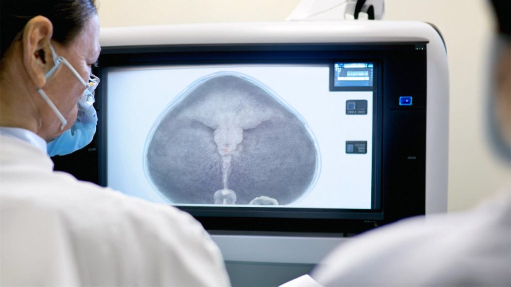 Early stage ovarian cancer ultrasound, especially transvaginal ultrasound, helps detect small tumors and cysts, aiding early diagnosis and improving outcomes 3 Early stage ovarian cancer ultrasound